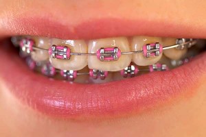 Metal Braces Closeup